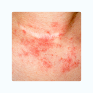 Say Goodbye to Diabetes with Ayurveda 13 Skin Condition